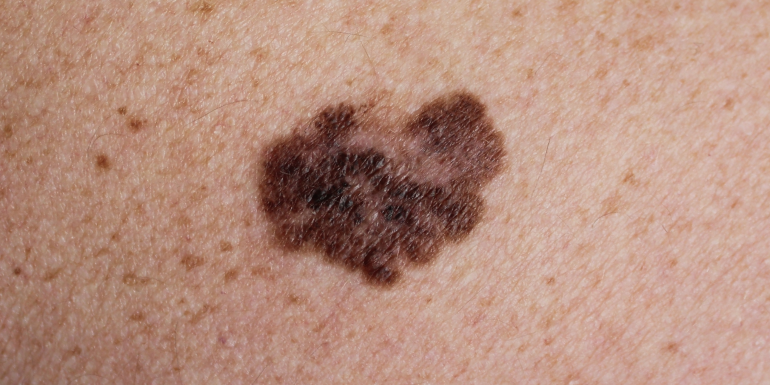 Auto-exame e melanoma, o que é e como tratar?